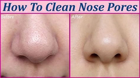 Double Cleansing · 3. . Clear liquid coming out of nose pores